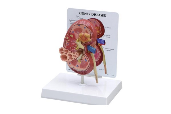 model chorej nerki - 1019550 3b scientific modele anatomiczne 2